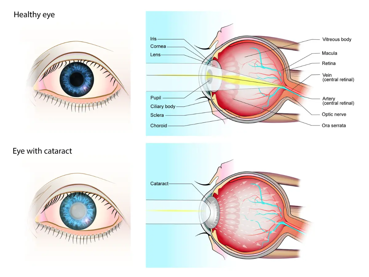 Advanced Cataract Surgery In Thane